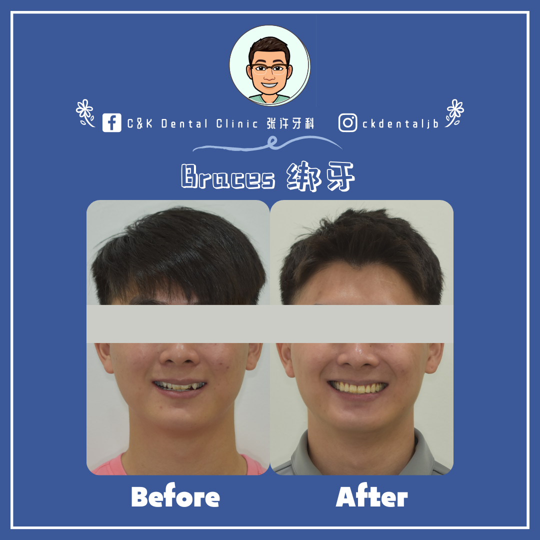 Wisdom Tooth